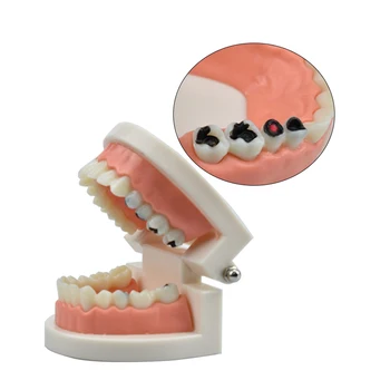 Стандартная модель кариозных полостей, модель кариеса у студента-стоматолога, Модель зубов, Демонстрационный инструмент для обучения детей